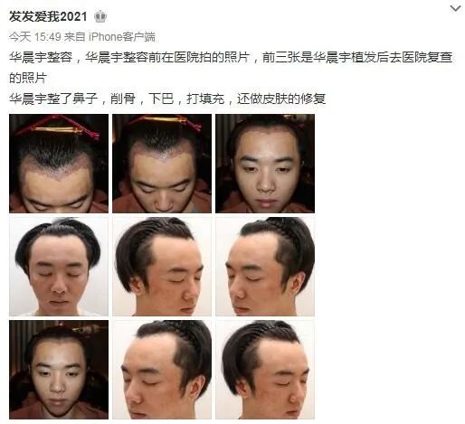 华晨宇整容_华晨宇整容后很奇怪_知乎华晨宇整容